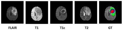 Overall Survival Prediction in Glioblastoma With Radiomic Features Using Machine Learning